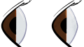 medical normal eye and keratoconus eye comparison black from the side 01