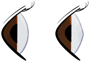 Normal and Keratoconus Comparison side view
