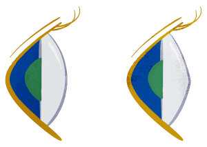 Normal and Keratoconus Comparison side view